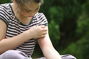 Girl with mosquito bites